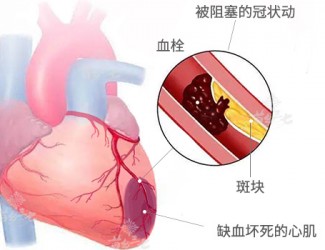 心臟病該怎么辦，且看臨床治療醫(yī)案一則